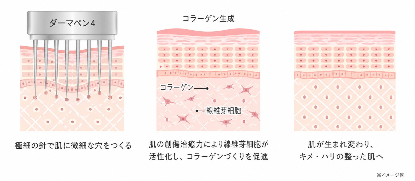 ダーマペン4の肌再生メカニズム：極細の針で微細な穴をつくり、創傷治癒力で線維芽細胞が活性化しコラーゲンづくりを促進、キメ・ハリの整った肌へ（イメージ図）