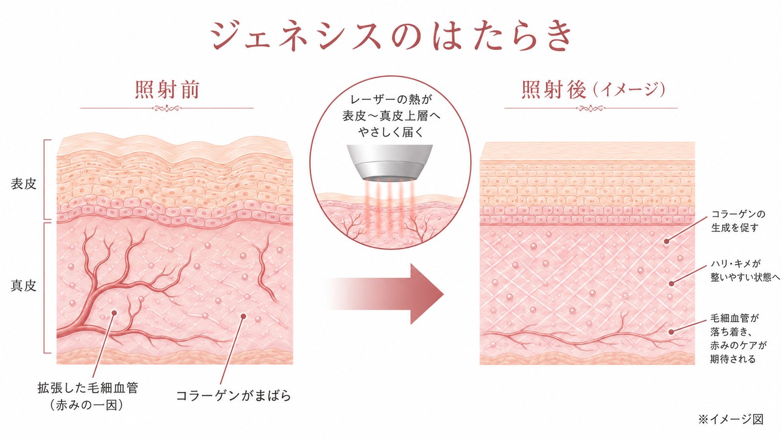 ジェネシスのはたらき：レーザーの熱が表皮〜真皮上層へやさしく届き、コラーゲンの生成を促し、毛細血管が落ち着き赤みのケアが期待される（イメージ図）