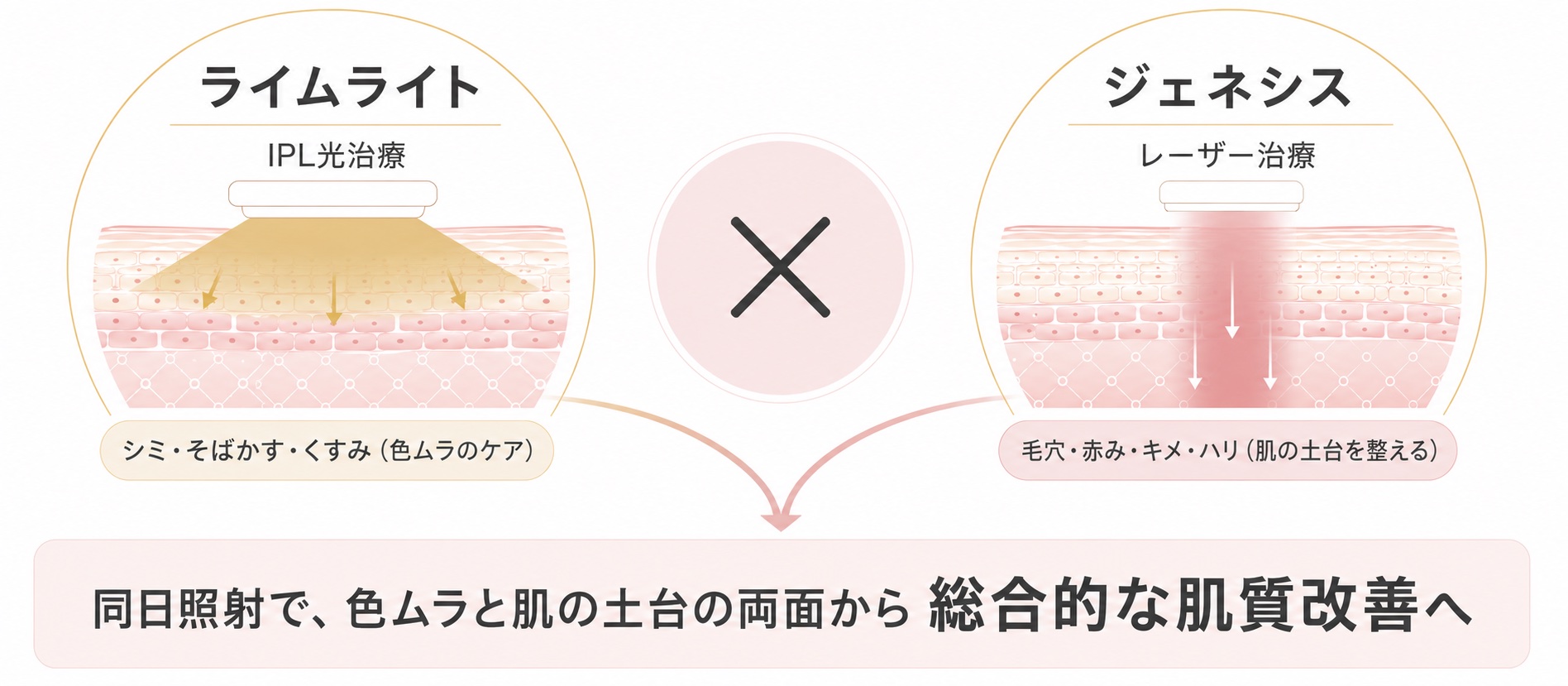 ライムライト（IPL光治療：シミ・そばかす・くすみなど色ムラのケア）とジェネシス（レーザー治療：毛穴・赤み・キメ・ハリなど肌の土台を整える）を同日照射で組み合わせ、両面から総合的な肌質改善を目指すイメージ図