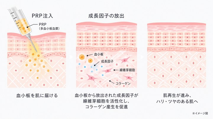 PRP皮膚再生療法のしくみ：PRPを肌に届け、血小板から放出された成長因子が線維芽細胞を活性化しコラーゲン産生を促進、肌再生が進みハリ・ツヤのある肌へ（イメージ図）